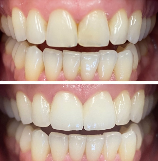 Before and after dental veneers comparison showing improved tooth alignment and whiteness.