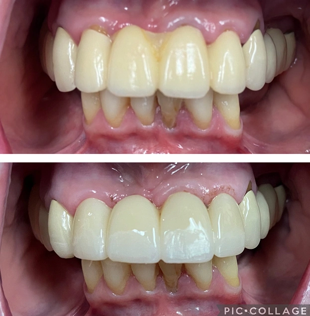 Before and after dental veneers comparison showing improved tooth whiteness and alignment.