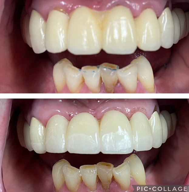 Before and after dental veneers showing improved tooth color and alignment on upper front teeth.