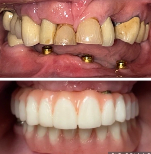 Before and after dental implants showing discolored teeth replaced with bright white prosthetic teeth.