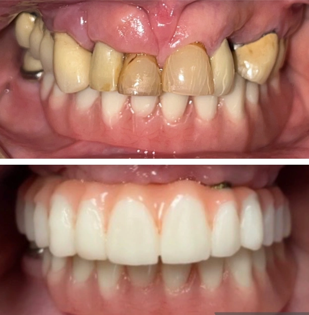 Before and after dental restoration showing severely damaged teeth transformed to bright white smile.