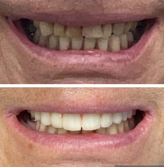 Before and after dental treatment showing improved tooth whiteness and alignment at Gold Coast Family Dental.