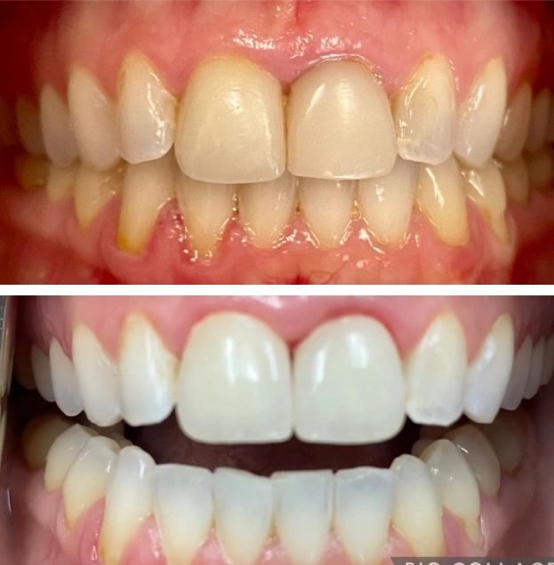 Before and after dental restoration showing improved tooth whiteness and alignment at Gold Coast Family Dental.