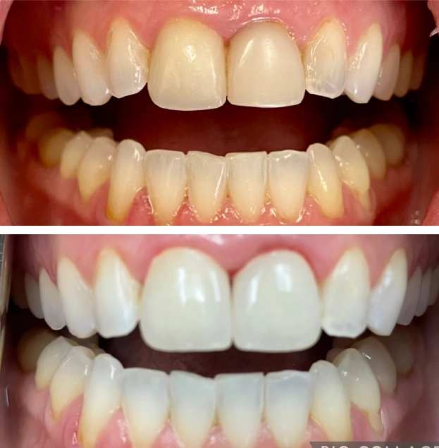 Before and after dental whitening treatment showing brightened upper and lower teeth.