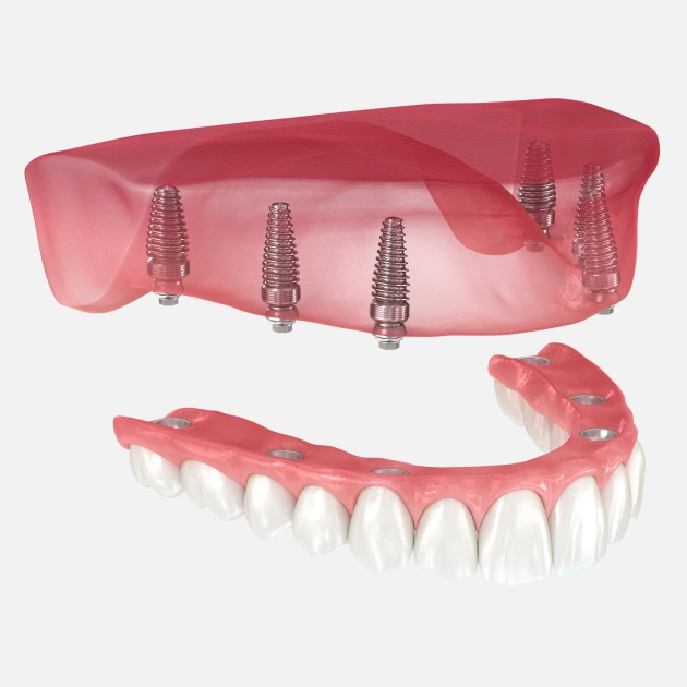 Dental implant prosthesis with four titanium screws and artificial teeth in pink gum material.