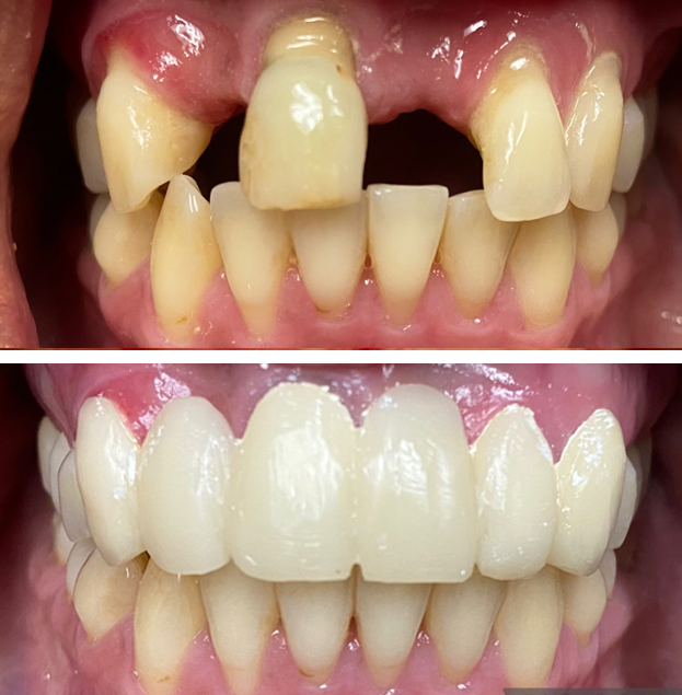 Before and after dental restoration showing improved tooth alignment and appearance using crowns and bridges.