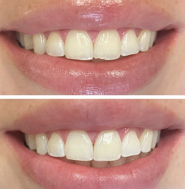 Before and after dental restoration showing improved tooth alignment and whitening results.