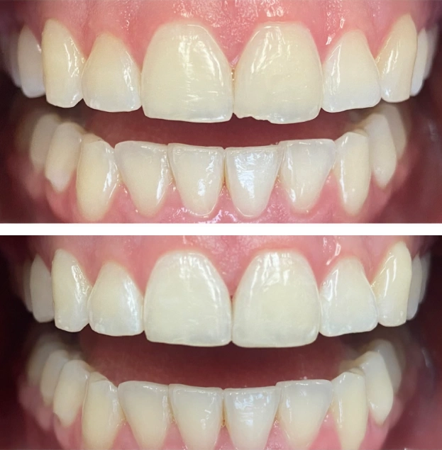 Before and after dental treatment showing improved tooth alignment and whiteness on Gold Coast Family Dental patient.