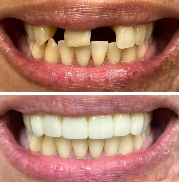 Before and after dental treatment showing damaged teeth restored to healthy, white smile.