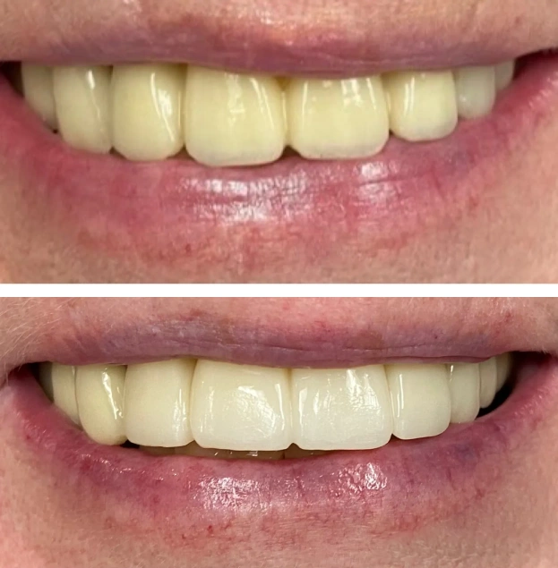 Before and after dental restoration showing improved tooth alignment and appearance.