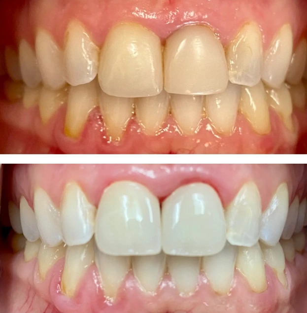 Before and after dental restoration showing improved tooth appearance and whiteness on Gold Coast Family Dental patient.