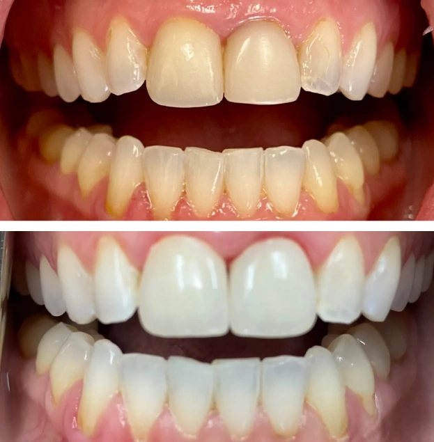 Before and after dental whitening comparison showing yellowed teeth transformed to bright white smile.