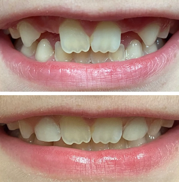 Before and after dental treatment showing improved tooth alignment and appearance at Gold Coast Family Dental.