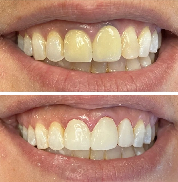 Before and after dental whitening results showing improved tooth brightness and whiteness.