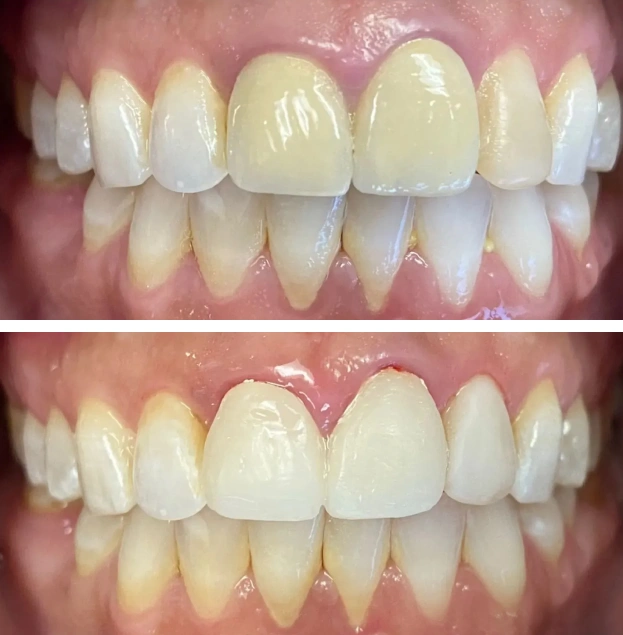 Before and after dental veneers showing improved tooth color and alignment on upper and lower teeth.