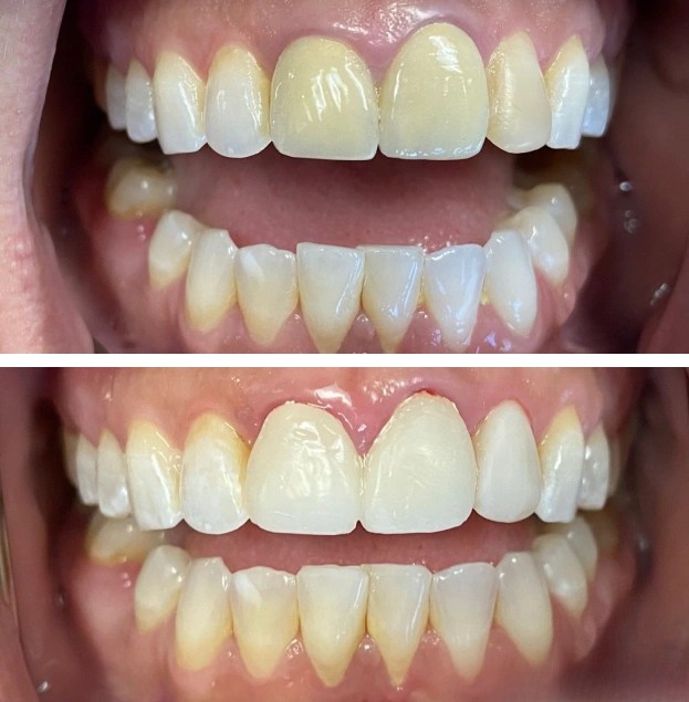 Before and after dental whitening treatment showing brightened upper and lower teeth.