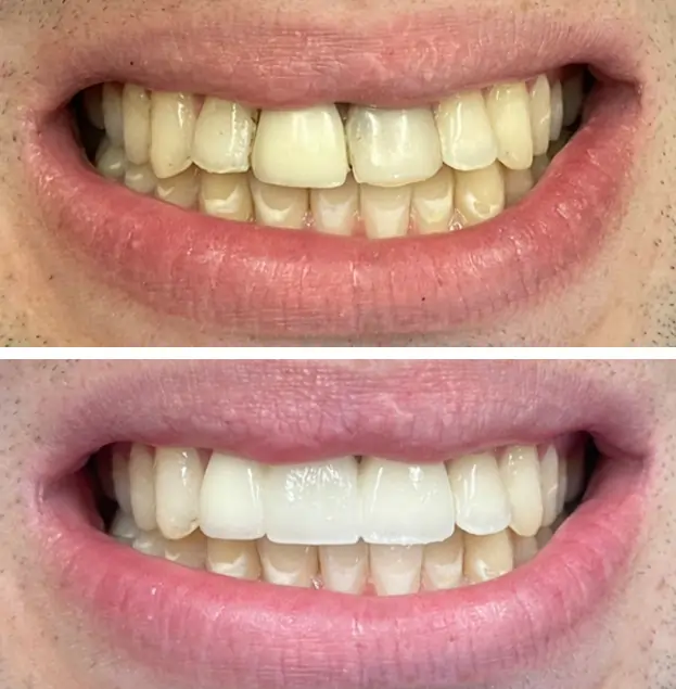 Before and after teeth whitening comparison showing improved brightness and whiteness of front teeth.