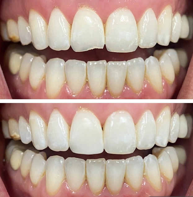 Before and after dental veneers showing improved tooth whiteness and alignment on upper and lower teeth.