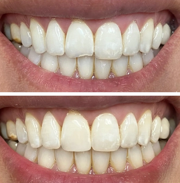 Before and after dental veneers showing improved tooth shape and alignment on upper teeth.