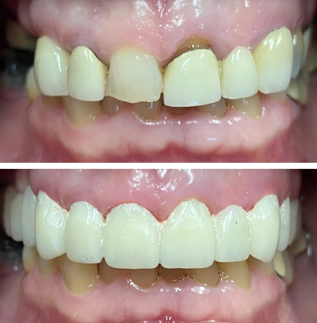 Before and after dental restoration showing improved tooth alignment and whiteness.