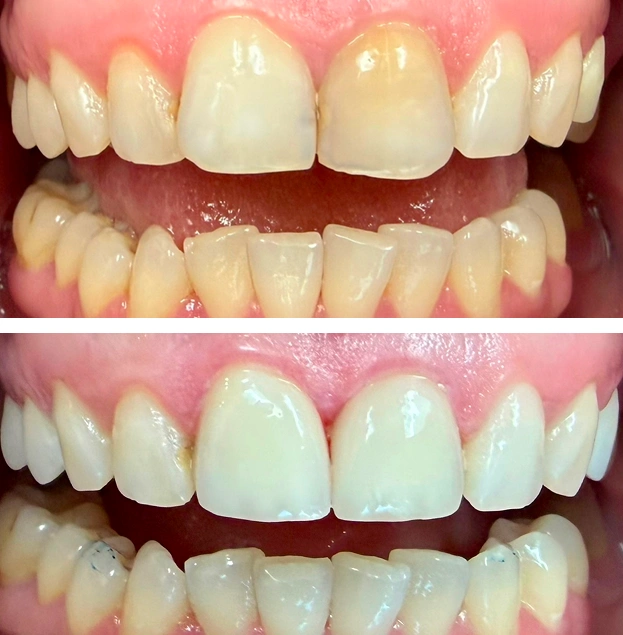 Before and after dental treatment showing tooth whitening and restoration results on upper and lower teeth.