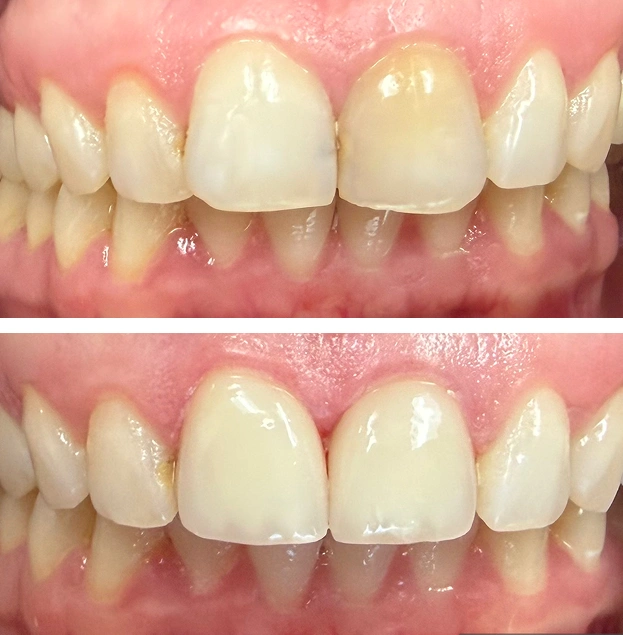 Before and after dental crowns showing improved tooth shape and alignment on front teeth.