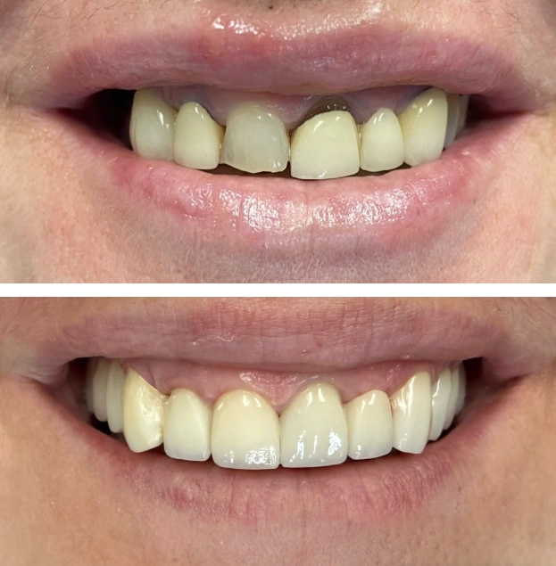 Before and after dental veneers showing improved tooth alignment and appearance.