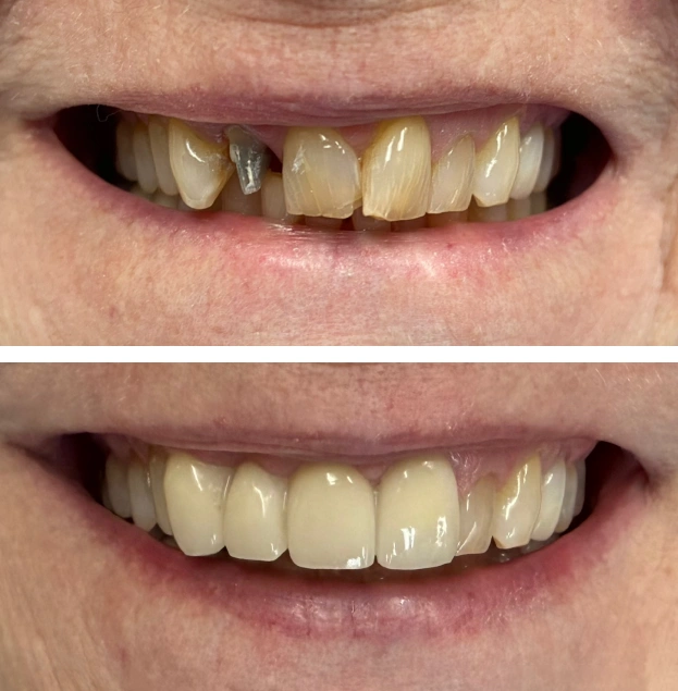 Before and after dental restoration showing improved tooth alignment and appearance.