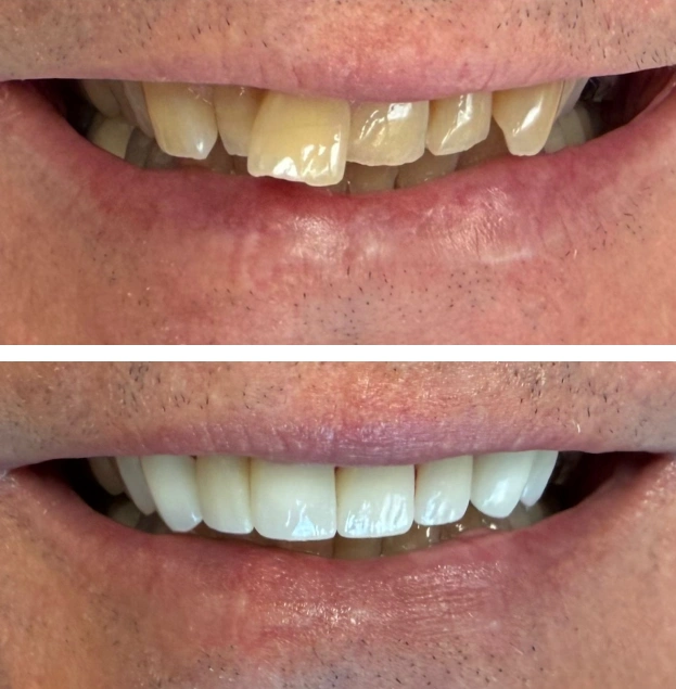 Before and after dental treatment showing teeth whitening and restoration results.