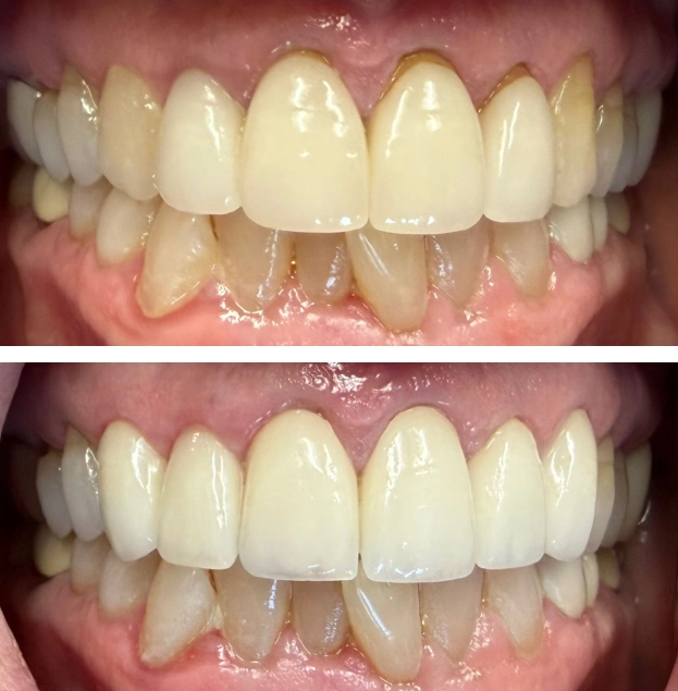 Before and after dental restoration showing improved tooth alignment and whiteness in clinical setting.