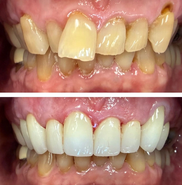 Before and after dental restoration showing yellowed upper teeth transformed to bright white veneers.