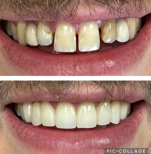 Before and after dental treatment showing improved tooth alignment and whiteness.