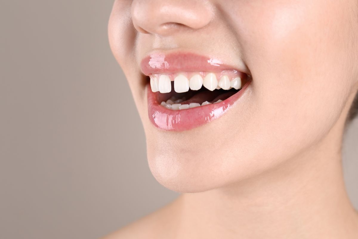 Gaps from Missing Teeth