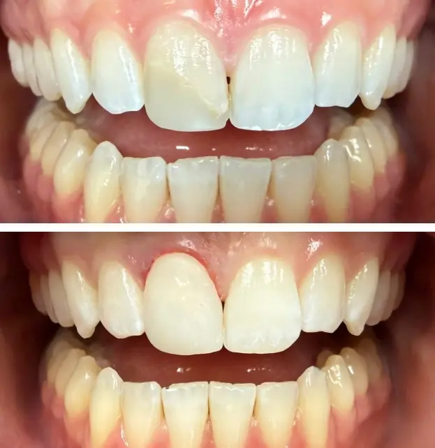 Before and after dental veneers showing improved tooth shape and whiteness in Port Washington.